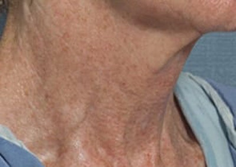 Fraxel Laser Resurfacing Before & After Gallery - Patient 133066527 - Image 1