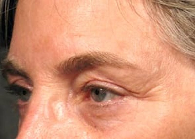 Ultherapy Before & After Gallery - Patient 133066528 - Image 1