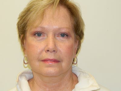 Mini-Facelift Before & After Gallery - Patient 133066532 - Image 2