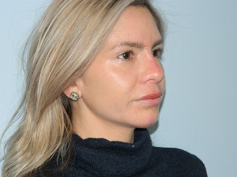 Non-Surgical Rhinoplasty and Injectable Fillers Before & After Gallery - Patient 133066526 - Image 4
