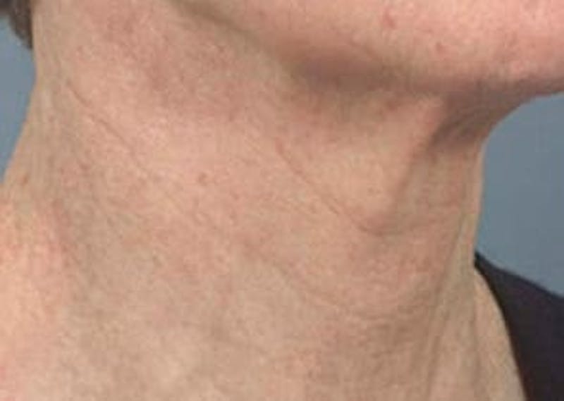 Fraxel Laser Resurfacing Before & After Gallery - Patient 133066527 - Image 2