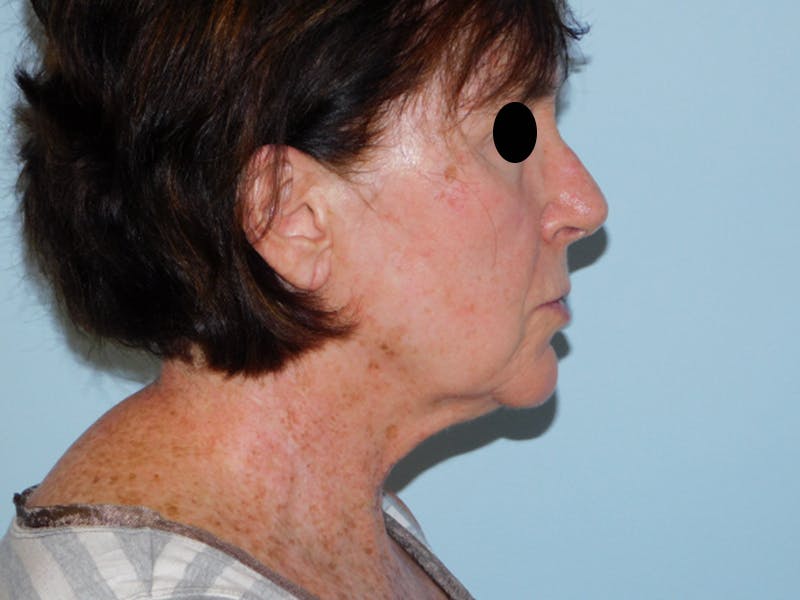Facelift Before & After Gallery - Patient 133066535 - Image 3