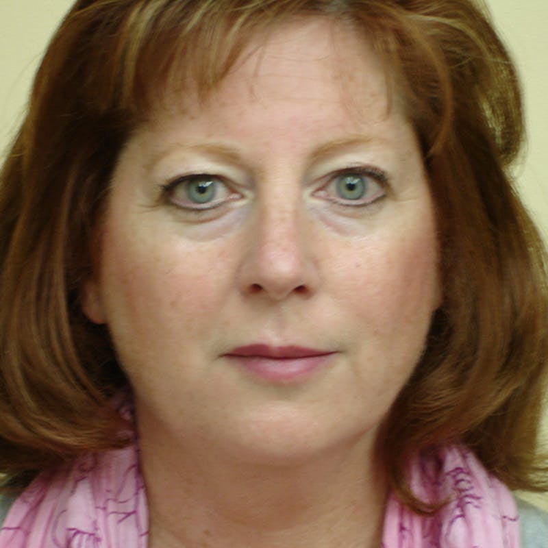 Chin Augmentation Before & After Gallery - Patient 133066536 - Image 3
