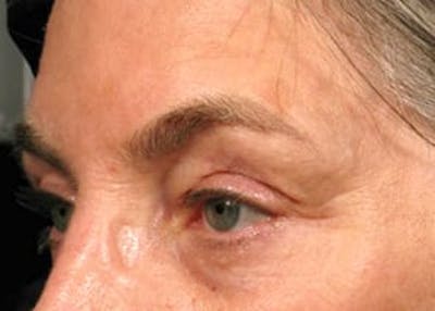 Ultherapy Before & After Gallery - Patient 133066528 - Image 2