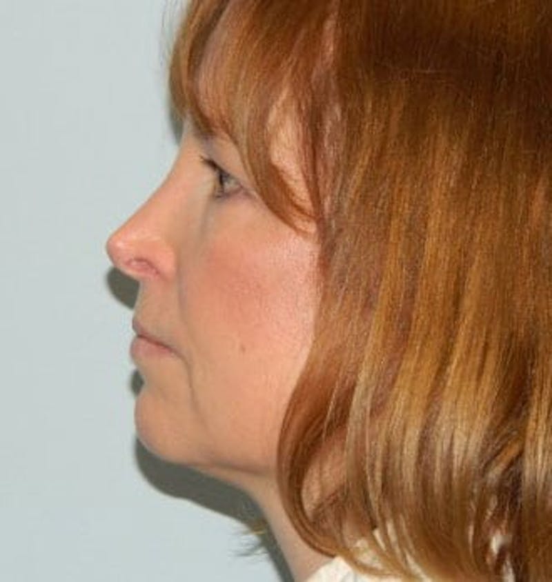 Revision Rhinoplasty Before & After Gallery - Patient 133066537 - Image 1