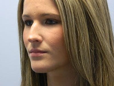 Non-Surgical Rhinoplasty and Injectable Fillers Before & After Gallery - Patient 133066531 - Image 1