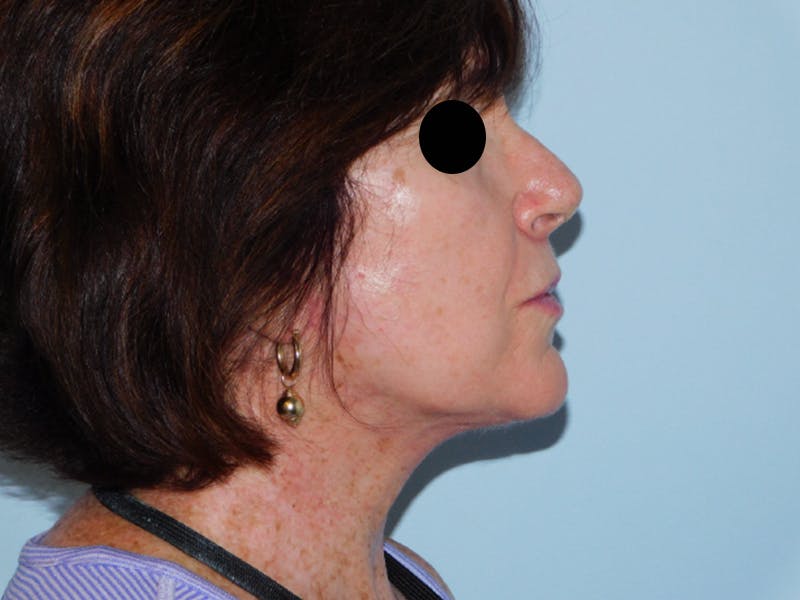 Facelift Before & After Gallery - Patient 133066535 - Image 4