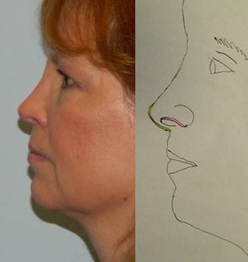 Revision Rhinoplasty Before & After Gallery - Patient 133066537 - Image 2