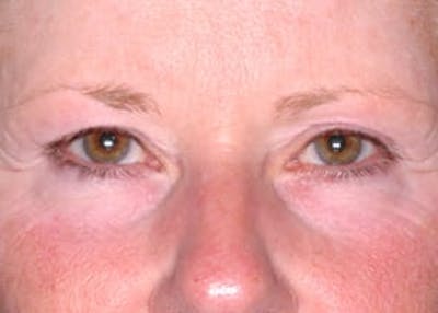 Ultherapy Before & After Gallery - Patient 133066529 - Image 1