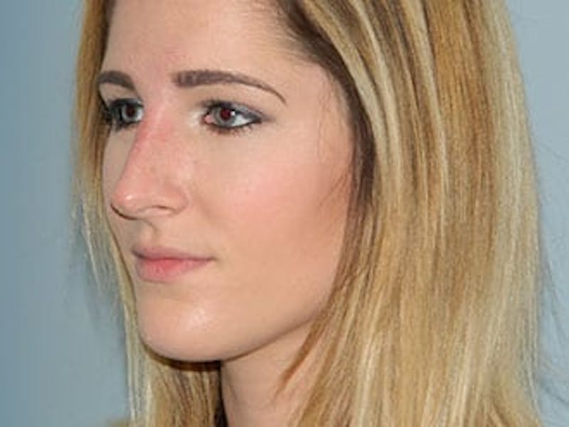 Non-Surgical Rhinoplasty and Injectable Fillers Before & After Gallery - Patient 133066531 - Image 2