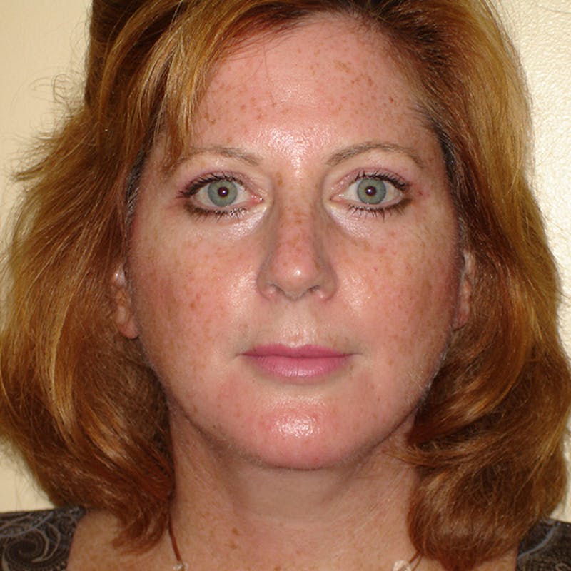 Chin Augmentation Before & After Gallery - Patient 133066536 - Image 4