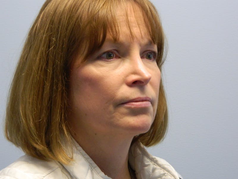 Revision Rhinoplasty Before & After Gallery - Patient 133066537 - Image 3