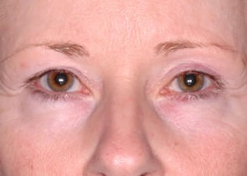 Ultherapy Before & After Gallery - Patient 133066529 - Image 2