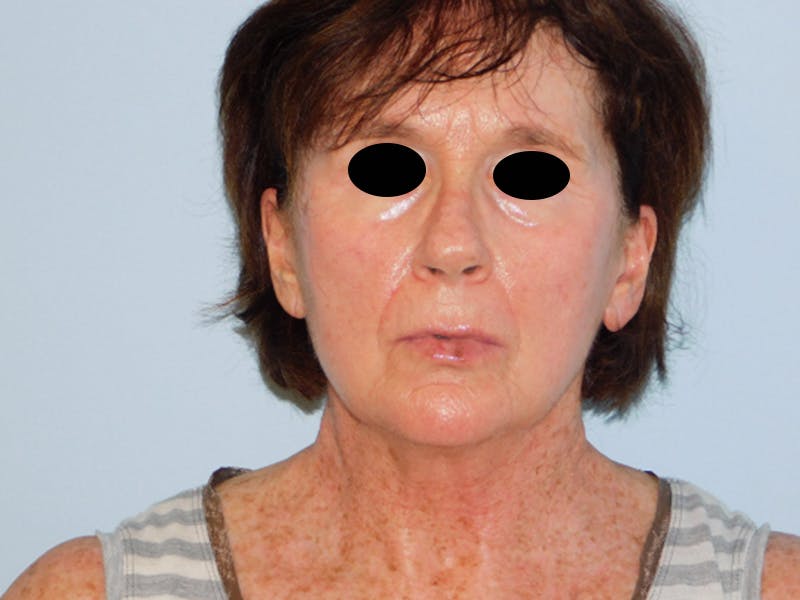 Facelift Before & After Gallery - Patient 133066535 - Image 5