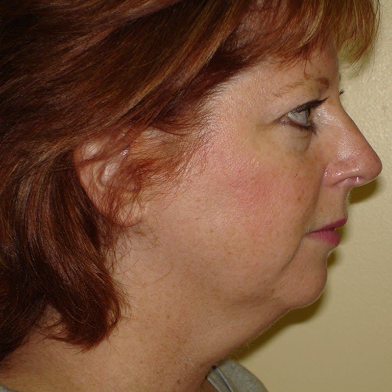 Chin Augmentation Before & After Gallery - Patient 133066536 - Image 5