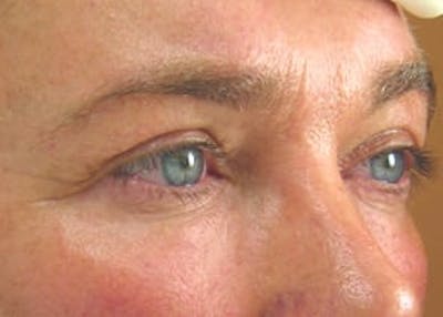 Ultherapy Before & After Gallery - Patient 133066533 - Image 1