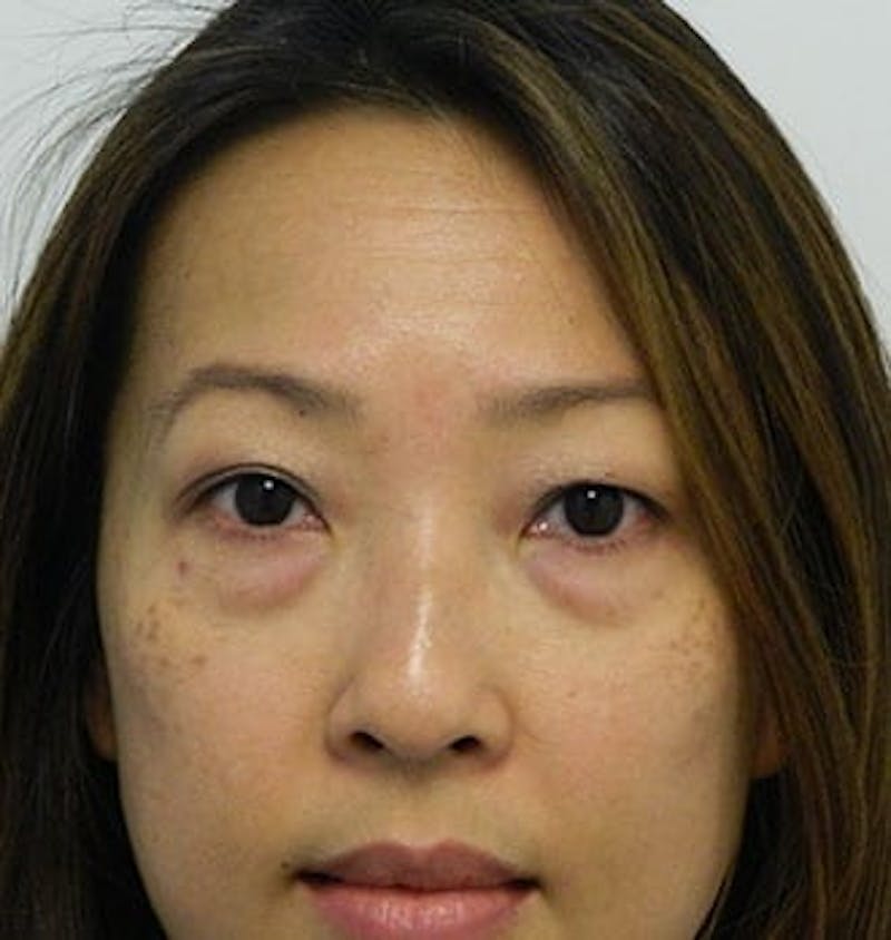 Blepharoplasty (Eyelid Lift) Before & After Gallery - Patient 133066534 - Image 1