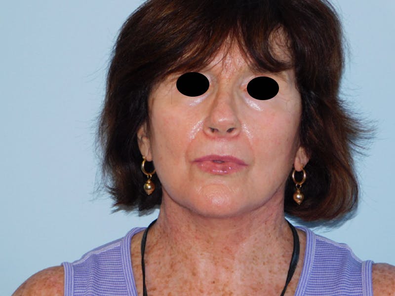 Facelift Before & After Gallery - Patient 133066535 - Image 6