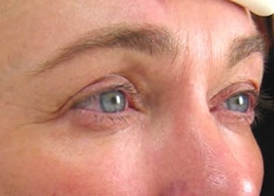 Ultherapy Before & After Gallery - Patient 133066533 - Image 2