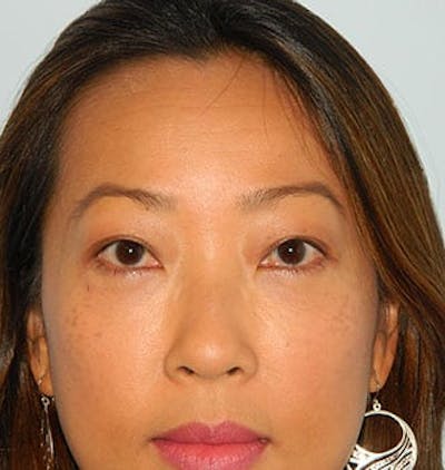 Blepharoplasty (Eyelid Lift) Before & After Gallery - Patient 133066534 - Image 2