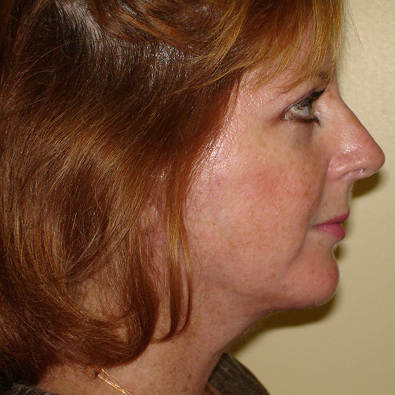 Chin Augmentation Before & After Gallery - Patient 133066536 - Image 6