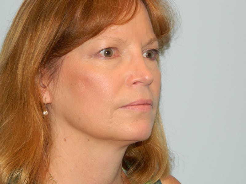 Revision Rhinoplasty Before & After Gallery - Patient 133066537 - Image 4