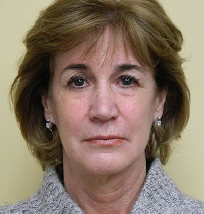 Mini-Facelift Before & After Gallery - Patient 133066539 - Image 1