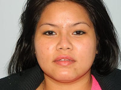 Non-Surgical Rhinoplasty and Injectable Fillers Before & After Gallery - Patient 133066540 - Image 2