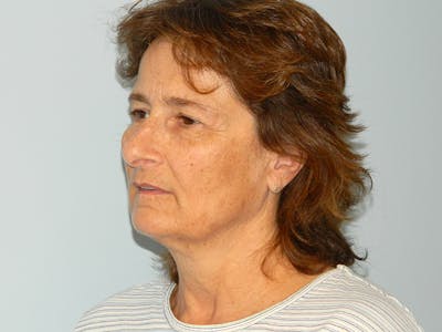 Facelift Before & After Gallery - Patient 133066542 - Image 1