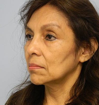Blepharoplasty (Eyelid Lift) Before & After Gallery - Patient 133066541 - Image 1