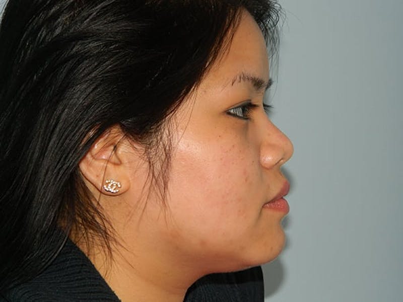 Non-Surgical Rhinoplasty and Injectable Fillers Before & After Gallery - Patient 133066540 - Image 3