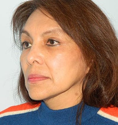 Blepharoplasty (Eyelid Lift) Before & After Gallery - Patient 133066541 - Image 2