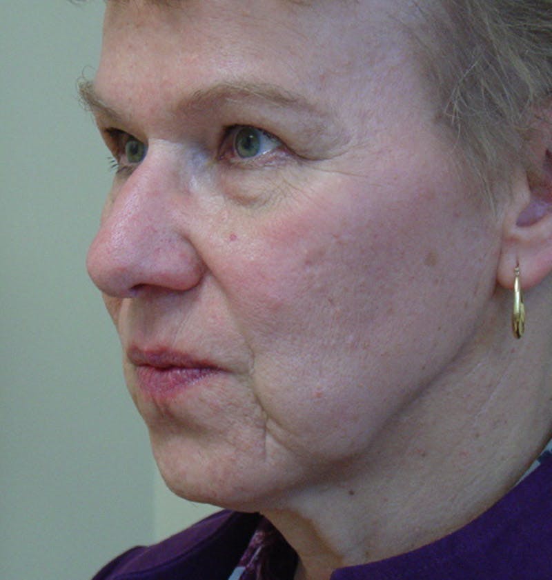 Chin Augmentation Before & After Gallery - Patient 133066543 - Image 1