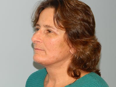 Facelift Before & After Gallery - Patient 133066542 - Image 2