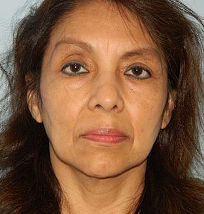 Blepharoplasty (Eyelid Lift) Before & After Gallery - Patient 133066541 - Image 3