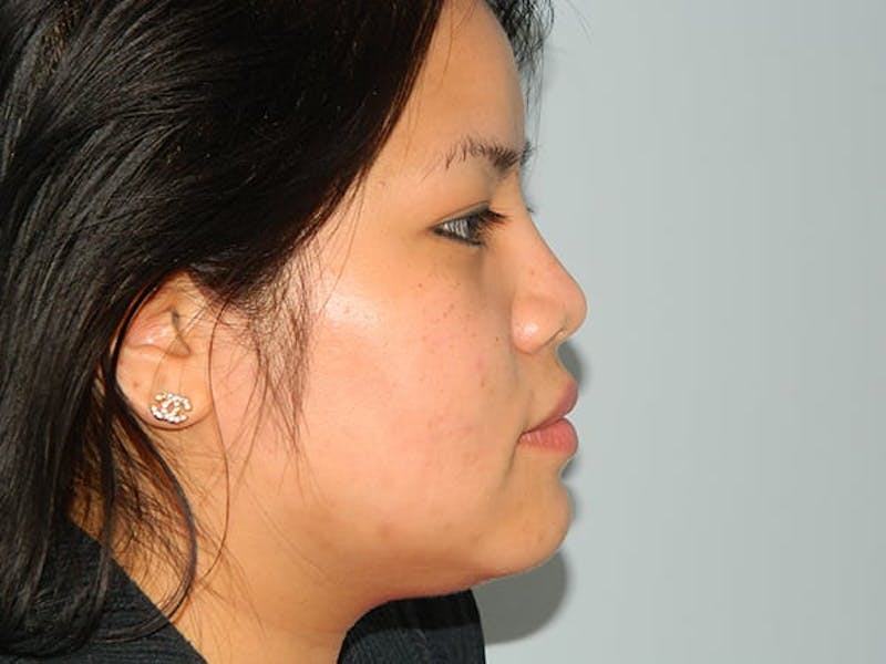 Non-Surgical Rhinoplasty and Injectable Fillers Before & After Gallery - Patient 133066540 - Image 4