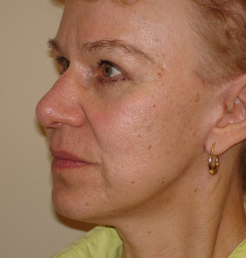 Chin Augmentation Before & After Gallery - Patient 133066543 - Image 2