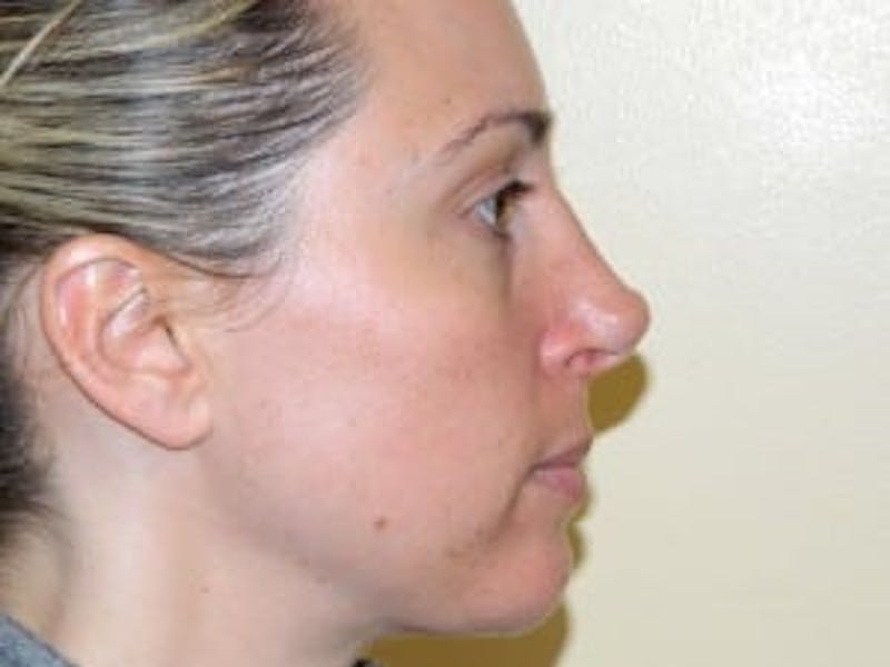 Revision Rhinoplasty Before & After Gallery - Patient 133066545 - Image 1