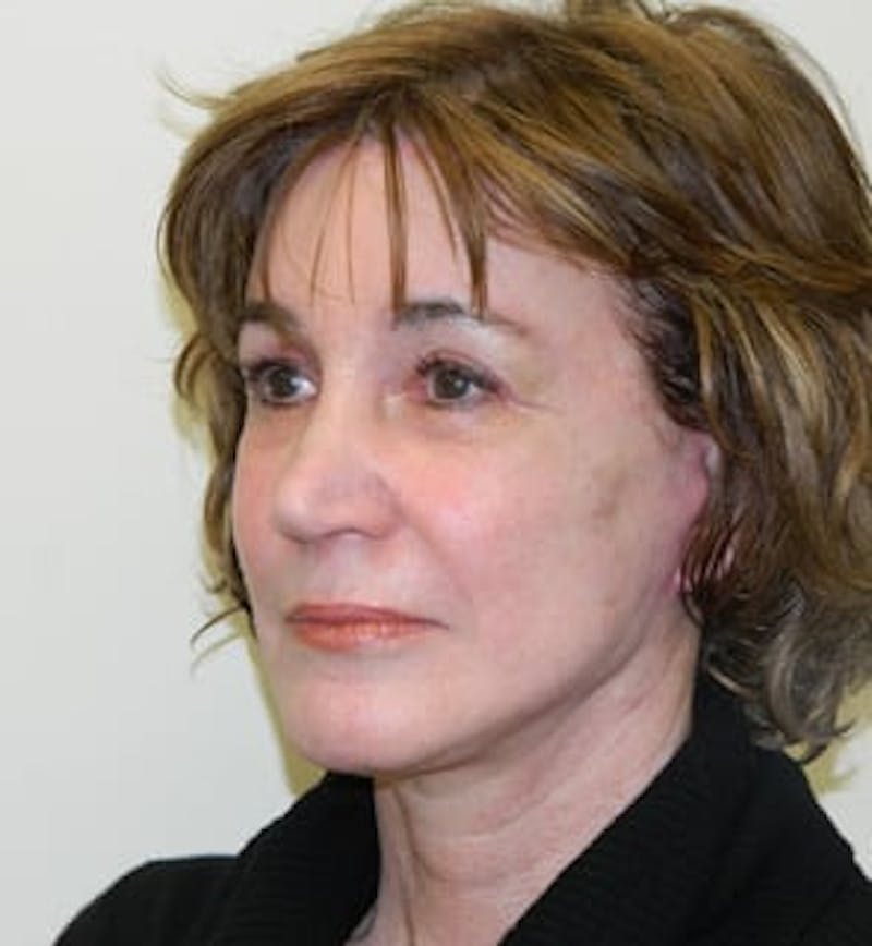 Mini-Facelift Before & After Gallery - Patient 133066539 - Image 4