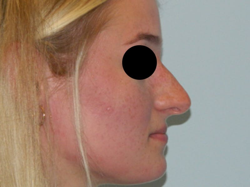 Rhinoplasty Before & After Gallery - Patient 133066549 - Image 1