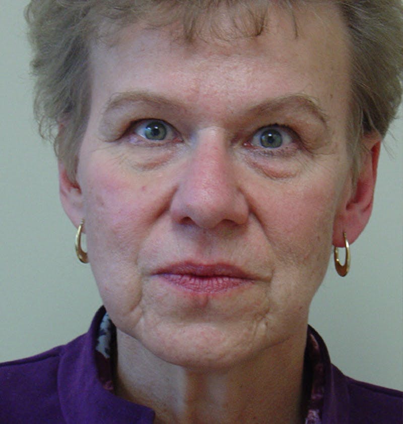 Chin Augmentation Before & After Gallery - Patient 133066543 - Image 3