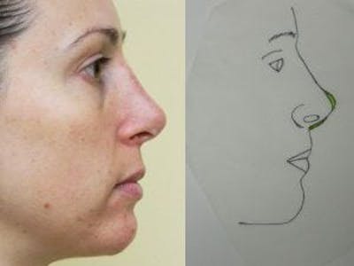 Revision Rhinoplasty Before & After Gallery - Patient 133066545 - Image 2