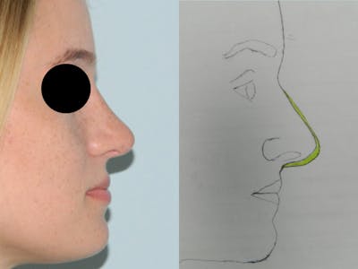 Rhinoplasty Before & After Gallery - Patient 133066549 - Image 2