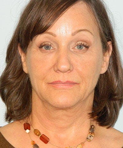 Mini-Facelift Before & After Gallery - Patient 133066546 - Image 1
