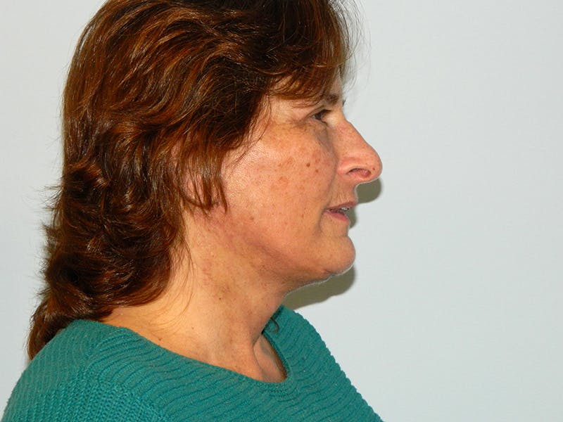 Facelift Before & After Gallery - Patient 133066542 - Image 4