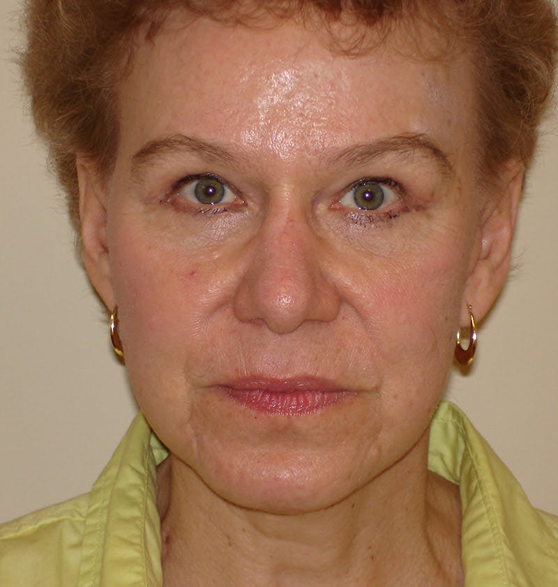 Chin Augmentation Before & After Gallery - Patient 133066543 - Image 4