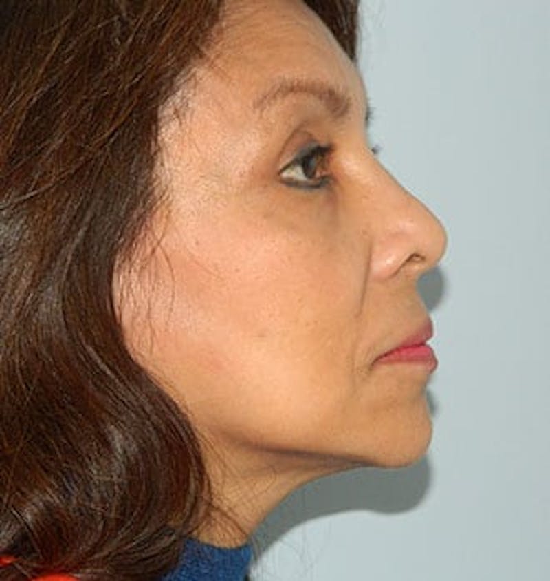 Blepharoplasty (Eyelid Lift) Before & After Gallery - Patient 133066541 - Image 6