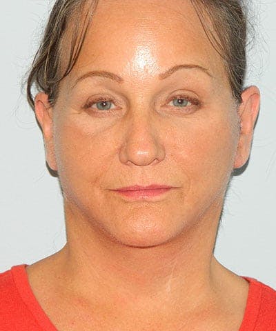 Mini-Facelift Before & After Gallery - Patient 133066546 - Image 2