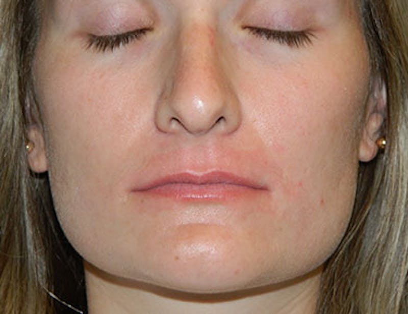 Non-Surgical Rhinoplasty and Injectable Fillers Before & After Gallery - Patient 133066544 - Image 1