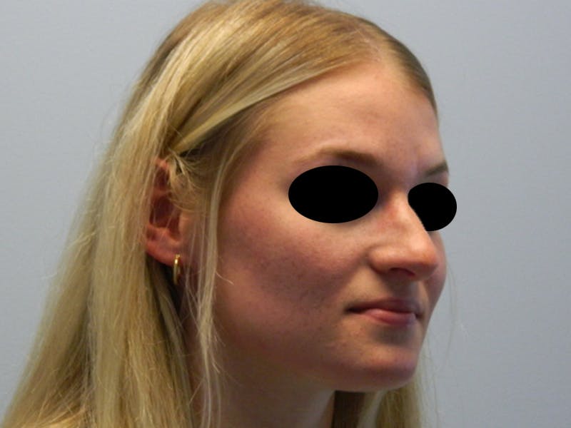 Rhinoplasty Before & After Gallery - Patient 133066549 - Image 3